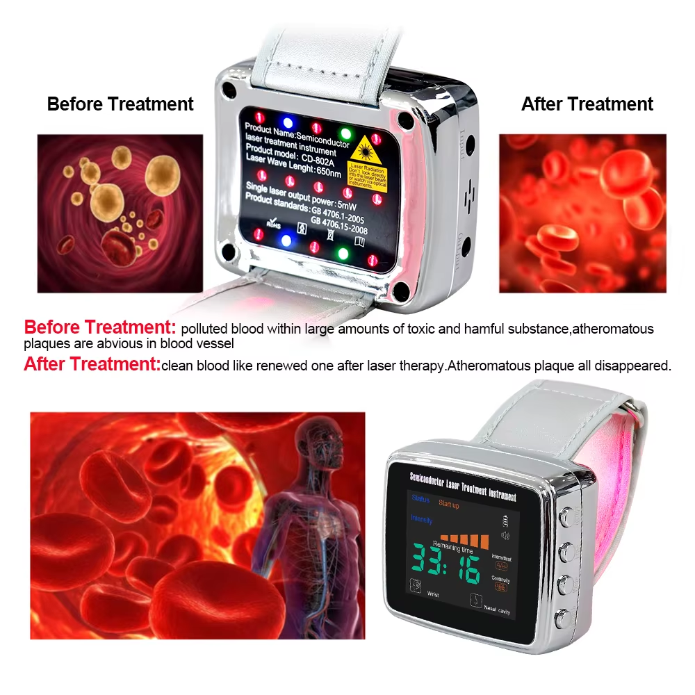 OPSLEA Jam Tangan Terapi Nano Laser Therapy Watch 13 Hole 650nm - CD-802A