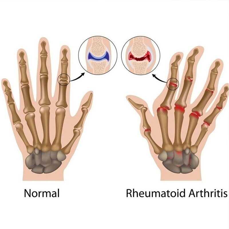 SAFEBET Sarung Tangan Terapi Anti Arthritis Therapy Glove 1 Pair - AY337